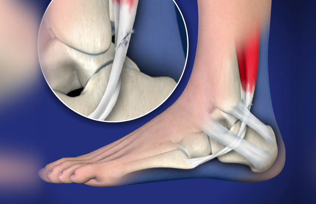 Stem Cell Therapy for Ankle Tendon Tears: Ankle Pain Treatment