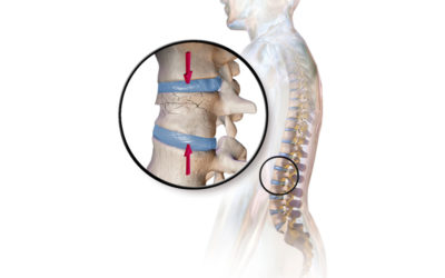 Stem Cell Therapy for Spinal Torn Discs: Treatment for Back pain