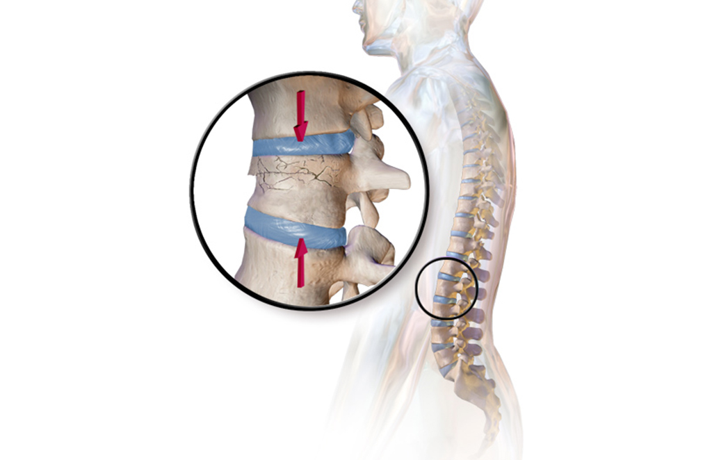 Stem Cell Therapy for Spinal Torn Discs
