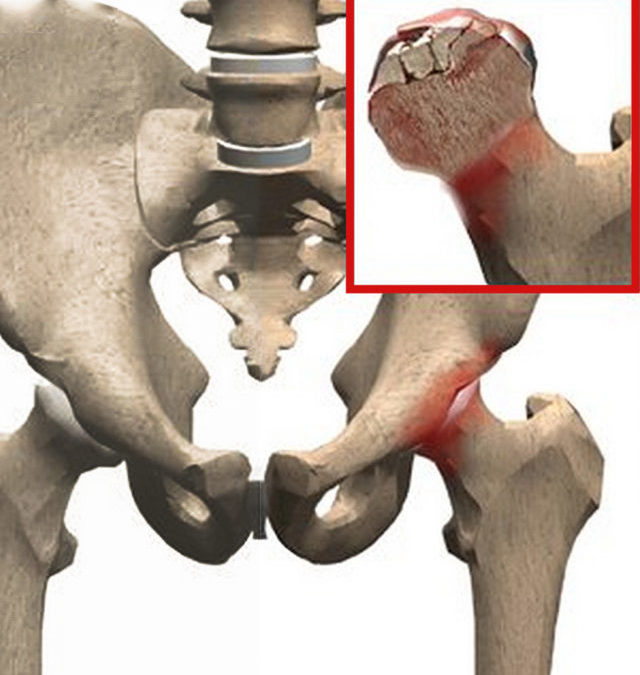 Hip AVN Treatment Without Surgery