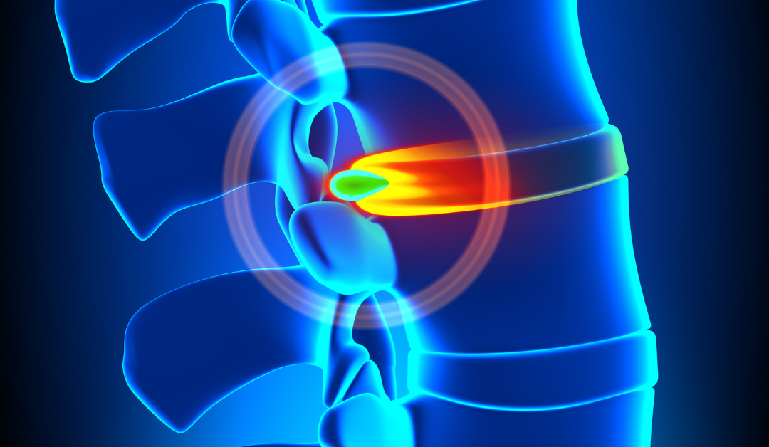 herniated disc treatment without surgery