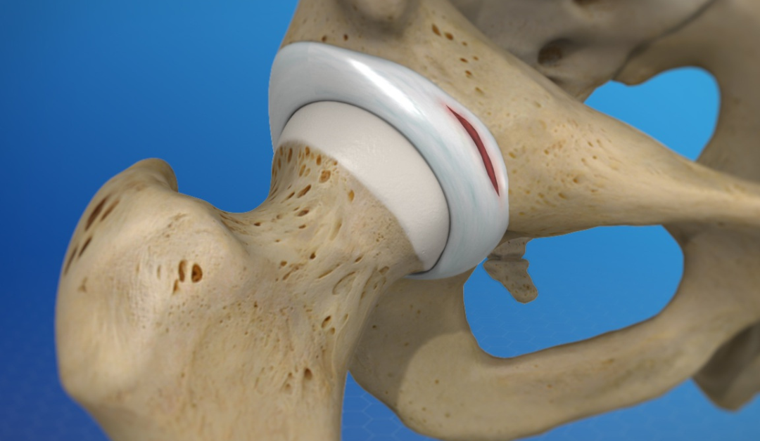 non surgical treatment for Hip Labral tear