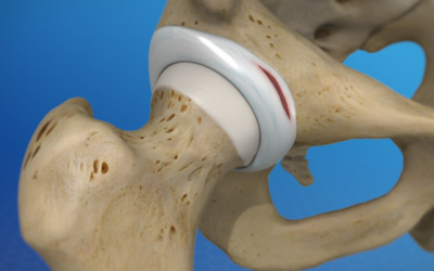 Say Goodbye to Hip Pain: Discover the Latest Non-Surgical Treatment for Hip Labral Tear