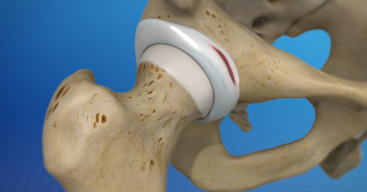 Hip Labral Tear Recovery Without Surgery